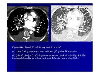 Figure 34a. Bn nữ 56 tuổi bị suy tim trái, khó thở.
(a) phù mô kẽ quanh mạch máu (mũi tên) giống như PE mạn tính.
(b) (cửa sổ phổi) phù mô kẽ quanh mạch máu, dấu kính mờ, dày rãnh liên
thùy và đường dày trơn láng. (mũi tên). Tràn dịch màng phổi 2 bên.
4
7
 