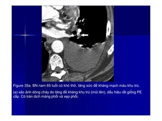 Figure 35a. BN nam 65 tuổi có khó thở, tăng sức đề kháng mạch máu khu trú.
(a) xảo ảnh dòng chảy do tăng đề kháng khu trú (mũi tên), dấu hiệu rất giống PE
cấp. Có tràn dịch màng phổi và xẹp phổi.
48
 