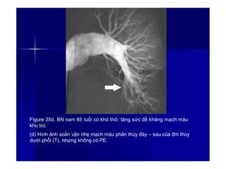 Figure 35d. BN nam 65 tuổi có khó thở, tăng sức đề kháng mạch máu
khu trú.
(d) Hình ảnh xoắn vặn nhẹ mạch máu phân thùy đáy – sau của đm thùy
dưới phổi (T), nhưng không có PE.
4
9
 