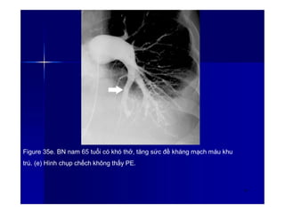Figure 35e. BN nam 65 tuổi có khó thở, tăng sức đề kháng mạch máu khu
trú. (e) Hình chụp chếch không thấy PE.
50
 