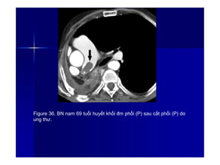 Figure 36. BN nam 69 tuổi huyết khối đm phổi (P) sau cắt phổi (P) do
ung thư.
5
1
 