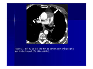 Figure 37. BN nữ 65 tuổi khó thở, có sarcoma đm phổi gốc (mũi
tên) di căn đm phổi (P). (đầu mũi tên).
52
 