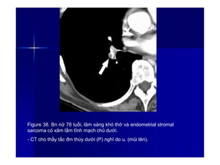 Figure 38. Bn nữ 78 tuổi, lâm sàng khó thở và endometrial stromal
sarcoma có xâm lấm tĩnh mạch chủ dưới.
- CT cho thấy tắc đm thùy dưới (P) nghĩ do u. (mũi tên).
53
 
