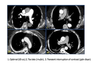 1.Optimal (tối ưu)2.T
oolate (muộn). 3.T
ransient interruptionof contrast(gián đoạn)
 