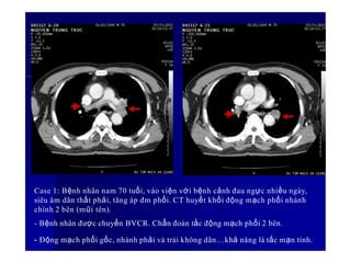 Case 1: Bệnh nhân nam 70 tuổi, vào viện với bệnh cảnh đau ngực nhiều ngày,
siêu âm dãn thất phải, tăng áp đm phổi. CT huyết khối động mạch phổi nhánh
chính 2 bên (mũi tên).
- Bệnh nhân được chuyển BVCR. Chẩn đoán tắc động mạch phổi 2 bên.
57
- Động mạch phổi gốc, nhánh phải và trái không dãn…khả năng là tắc mạn tính.
 