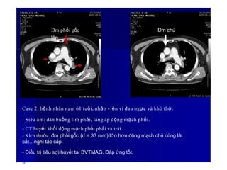 Đm phổi gốc Đm chủ
lên
Case 2: bệnh nhân nam 61 tuổi, nhập viện vì đau ngực và khó thở.
- Siêu âm: dãn buồng tim phải, tăng áp động mạch phổi.
- CT huyết khối động mạch phổi phải và trái.
- Kích thước đm phổi gốc (d = 33 mm) lớn hơn động mạch chủ cùng lát
cắt…nghĩ tắc cấp.
- Điều trị tiêu sợi huyết tại BVTMAG. Đáp ứng tốt.
58
 