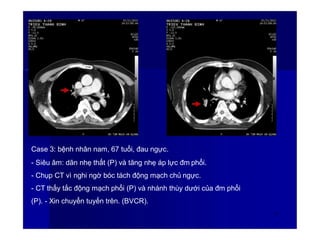 Case 3: bệnh nhân nam, 67 tuổi, đau ngực.
- Siêu âm: dãn nhẹ thất (P) và tăng nhẹ áp lực đm phổi.
- Chụp CT vì nghi ngờ bóc tách động mạch chủ ngực.
- CT thấy tắc động mạch phổi (P) và nhánh thùy dưới của đm phổi
(P). - Xin chuyển tuyến trên. (BVCR).
59
 