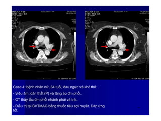 Case 4: bệnh nhân nữ, 64 tuổi, đau ngực và khó thở.
- Siêu âm: dãn thất (P) và tăng áp đm phổi.
- CT thấy tắc đm phổi nhánh phải và trái.
- Điều trị tại BVTMAG bằng thuốc tiêu sợi huyết. Đáp ứng
tốt.
60
 