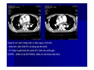 Case 6: bn nam nhập viện vì đau ngực, khó thở.
- Siêu âm: dãn thất (P) và tăng áp đm phổi.
- CT thấy huyết khối đm phổi (P). Dãn đm phổi gốc.
COPD. - Điều trị tại BVTMAG. (điều trị nội khoa bảo tồn).
62
 
