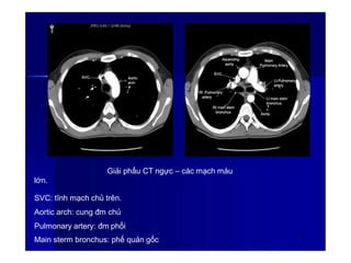 Giải phẩu CT ngực – các mạch máu
lớn.
SVC: tĩnh mạch chủ trên.
Aortic arch: cung đm chủ
Pulmonary artery: đm phổi
Main sterm bronchus: phế quản gốc
63
 