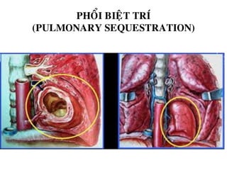 PHOÅI BIEÄT TRÍ
(PULMONARY SEQUESTRATION)
 