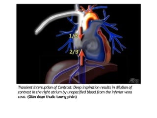 Transient Interruption of Contrast: Deep inspiration results in dilution of
contrast in the right atrium by unopaciﬁed blood from the inferior vena
cava. (Gián đoạn thuốc tương phản)
 
