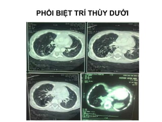 PHỔI BIỆT TRÍ THÙY DƯỚI
 