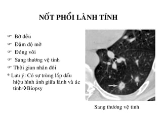 NOÁT PHOÅI LAØNH TÍNH
 Bôø ñeàu
 Ñaäm ñoä môõ
 Ñoùng voâi
 Sang thöông veä tinh
 Thôøi gian nhaân ñoâi
* Löu yù: Coù söï truøng laép daáu
hieäu hình aûnh giöõa laønh vaø aùc
tínhBiopsy
Sang thöông veä tinh
 