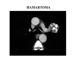 HAMARTOMA
 