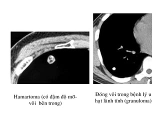 Hamartoma (coù ñaäm ñoä môõ-
voâi beân trong)
Ñoùng voâi trong beänh lyù u
haït laønh tính (granuloma)
 