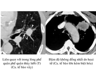 Ñaäm ñoä khoâng ñoàng nhaát do hoïai
töû (Ca. teá baøo lôùn keùm bieät hoùa)
Lieân quan vôùi trong loøng pheá
quaûn pheá quaûn thuøy löôõi (T)
(Ca. teá baøo vaûy)
 
