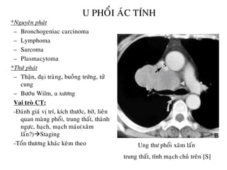 U PHOÅI AÙC TÍNH
*Nguyeân phaùt
– Bronchogeniac carcinoma
– Lymphoma
– Sarcoma
– Plasmacytoma
*Thöù phaùt
– Thaän, ñaïi traøng, buoàng tröùng, töû
cung
– Böôùu Wilm, u xöông
Vai troø CT:
-Ñaùnh giaù vò trí, kích thöôùc, bôø, lieân
quan maøng phoåi, trung thaát, thaønh
ngöïc, haïch, maïch maùu(xaâm
laán?)Staging
-Toån thöông khaùc keøm theo Ung thö phoåi xaâm laán
trung thaát, tónh maïch chuû treân [S]
s
 