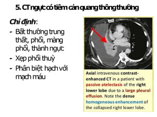 5.CTngựccótiêmcảnquangthôngthường
Chỉđịnh:
-
‐ Bấtthườngtrung
thất, phổi, màng
phổi, thànhngực
-
‐ Xẹpphổithuỳ
-
‐ Phânbiệt hạchvới
mạchmáu
 