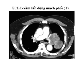 SCLC-xaâm laán ñoäng maïch phoåi (T).
 