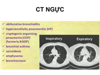 6.CThaithìhítvàovàthởra
Chỉđịnh: Bệnhlý gâytắc nghẽnđườngdẫnkhí:
CT NGỰC
 