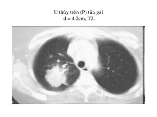 U thuøy treân (P) tuûa gai
d = 4.2cm, T2.
 