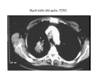 Haïch tröôùc khí quaûn, T2N2
 