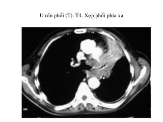 U roán phoåi (T). T4. Xeïp phoåi phía xa
 