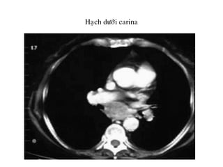Haïch döôùi carina
 