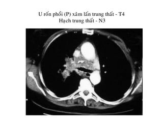 U roán phoåi (P) xaâm laán trung thaát - T4
Haïch trung thaát - N3
 