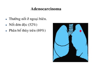 Adenocarcinoma
 Thöôøng noát ôû ngoaïi bieân.
 Noát ñôn ñoäc (52%)
 Phaân boá thuøy treân (69%)
 