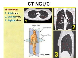 • Axial: ngang,Sagittal: đứng dọc,Coronal: đứngngang
CT NGỰC
 