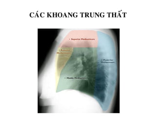 CAÙC KHOANG TRUNG THAÁT
 