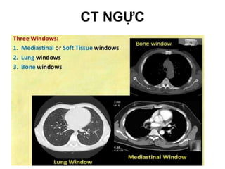 CỬASỔ:
1. T
rungthất/mômềm(mediastinalwindows)
2. Phổi (lungwindows)
3. Xương (bonewindows)
CT NGỰC
 