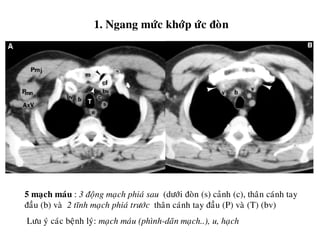 1. Ngang möùc khôùp öùc ñoøn
5 maïch maùu : 3 ñoäng maïch phiaù sau (döôùi ñoøn (s) caûnh (c), thaân caùnh tay
ñaàu (b) vaø 2 tónh maïch phiaù tröôùc thaân caùnh tay ñaàu (P) vaø (T) (bv)
Löu yù caùc beänh lyù: maïch maùu (phình-daõn maïch..), u, haïch
 