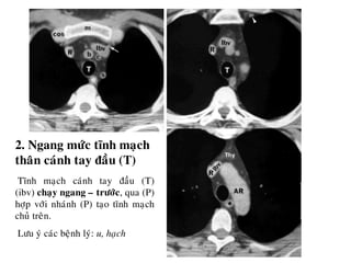 2. Ngang möùc tónh maïch
thaân caùnh tay ñaàu (T)
Tónh maïch caùnh tay ñaàu (T)
(ibv) chaïy ngang – tröôùc, qua (P)
hôïp vôùi nhaùnh (P) taïo tónh maïch
chuû treân.
Löu yù caùc beänh lyù: u, haïch
 