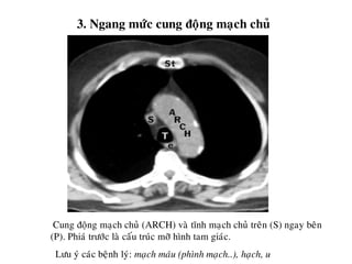 3. Ngang möùc cung ñoäng maïch chuû
Cung ñoäng maïch chuû (ARCH) vaø tónh maïch chuû treân (S) ngay beân
(P). Phiaù tröôùc laø caáu truùc môõ hình tam giaùc.
Löu yù caùc beänh lyù: maïch maùu (phình maïch..), haïch, u
 