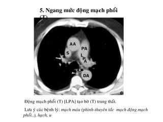 5. Ngang möùc ñoäng maïch phoåi
(T)
Ñoäng maïch phoåi (T) [LPA] taïo bôø (T) trung thaát.
Löu yù caùc beänh lyù: maïch maùu (phình-thuyeân taéc maïch ñoäng maïch
phoåi..), haïch, u
 