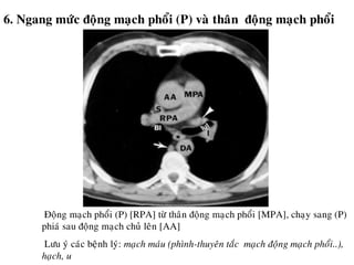 6. Ngang möùc ñoäng maïch phoåi (P) vaø thaân ñoäng maïch phoåi
Ñoäng maïch phoåi (P) [RPA] töø thaân ñoäng maïch phoåi [MPA], chaïy sang (P)
phiaù sau ñoäng maïch chuû leân [AA]
Löu yù caùc beänh lyù: maïch maùu (phình-thuyeân taéc maïch ñoäng maïch phoåi..),
haïch, u
 