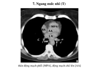 7. Ngang möùc nhó (T)
thaân ñoäng maïch phoåi [MPA], ñoäng maïch chuû leân [AA]
 