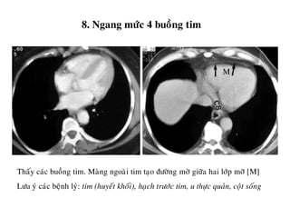 8. Ngang möùc 4 buoàng tim
Thaáy caùc buoàng tim. Maøng ngoaøi tim taïo ñöôøng môø giöõa hai lôùp môõ [M]
Löu yù caùc beänh lyù: tim (huyeát khoái), haïch tröôùc tim, u thöïc quaûn, coät soáng
M
 