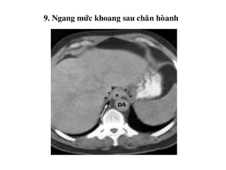 9. Ngang möùc khoang sau chaân hoøanh
 