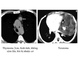 Thymoma 2cm, laønh tính, khoâng
xaâm laán, b/n bò nhöôïc cô
Teratoma
 