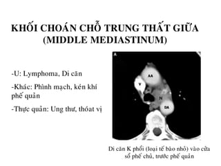 KHOÁI CHOAÙN CHOÃ TRUNG THAÁT GIÖÕA
(MIDDLE MEDIASTINUM)
-U: Lymphoma, Di caên
-Khaùc: Phình maïch, keùn khí
pheá quaûn
-Thöïc quaûn: Ung thö, thoùat vò
Di caên K phoåi (loaïi teá baøo nhoû) vaøo cöûa
soå pheá chuû, tröôùc pheá quaûn
 