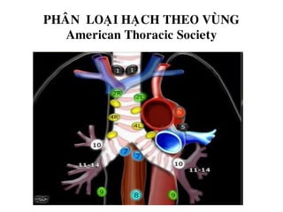 PHAÂN LOAÏI HAÏCH THEO VUØNG
American Thoracic Society
 