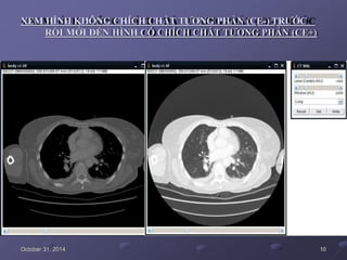 XEM HÌNH KHÔNG CHÍCH CHẤT TƯƠNG PHẢN (CE-) TRƯỚC
RỒI MỚI ĐẾN HÌNH CÓ CHÍCH CHẤT TƯƠNG PHẢN (CE+)
October 31, 2014 10
 