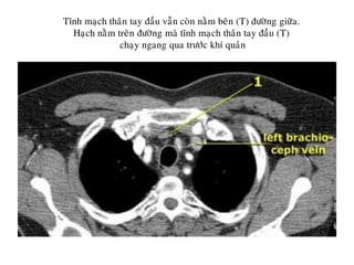 Tónh maïch thaân tay ñaàu vaãn coøn naèm beân (T) ñöôøng giöõa.
Haïch naèm treân ñöôøng maø tónh maïch thaân tay ñaàu (T)
chaïy ngang qua tröôùc khí quaûn
 