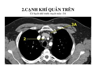 2.CAÏNH KHÍ QUAÛN TREÂN
Coù haïch nhoû tröôùc maïch maùu -3A
 