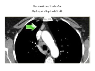 Haïch tröôùc maïch maùu -3A.
Haïch caïnh khí quaûn döôùi -4R.
 