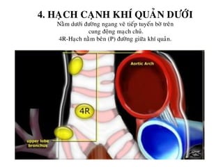 4. HAÏCH CAÏNH KHÍ QUAÛN DÖÔÙI
Naèm döôùi ñöôøng ngang veõ tieáp tuyeán bôø treân
cung ñoäng maïch chuû.
4R-Haïch naèm beân (P) ñöôøng giöõa khí quaûn.
 